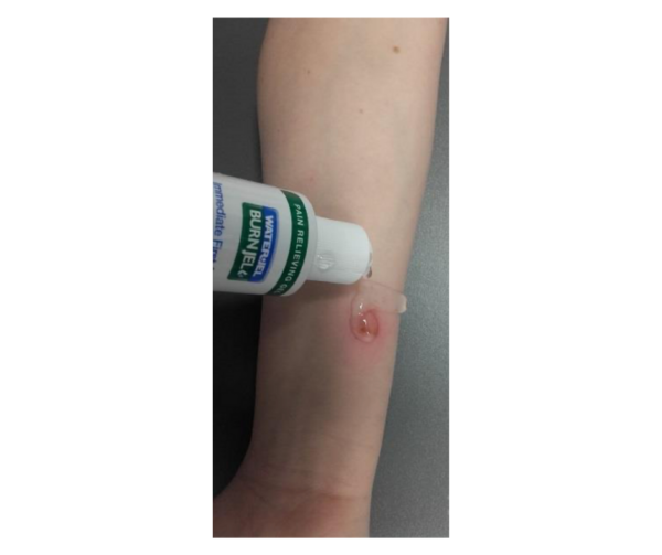 Gelis nudegimams Burn Jel 4 Gelis nudegimams Burn Jel